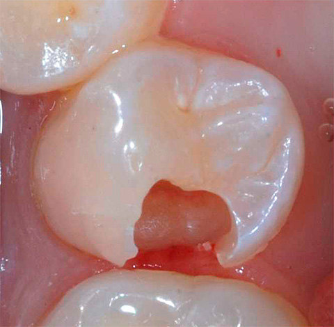 Tooth photo before treatment