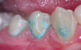 يشير التلوين المستمر لمينا الأسنان باللون الأزرق الميثيلين إلى بداية نزعها للمعادن