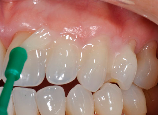 Des procédures de reminéralisation régulières réduisent considérablement le risque de carie dentaire et constituent une excellente mesure préventive.