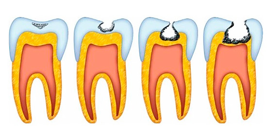 ขั้นตอนของการเกิดฟันผุ - เห็นได้ชัดว่าเนื้อฟันของฟันนั้นได้รับผลกระทบหลังจากที่เคลือบฟันถูกทำลายอย่างรุนแรง