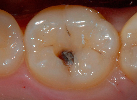 Tann karies er et irreversibelt tannråte, det vil si at den ødelagte delen må byttes ut med en fylling