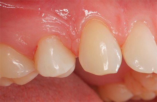 Ak sa dokonca zdá, že nie všetky vaše zuby sú také zlé, ale cítite bolesť z horúčavy alebo chladu, možno ide o zubný kaz