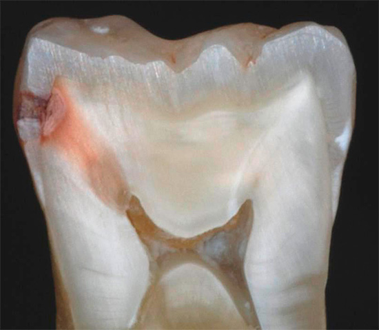 Pada insisi gigi yang terkena karies, ia dapat dilihat dengan jelas bahawa jangkitan menembusi jauh ke dalam dentin, kepada pulpa itu sendiri