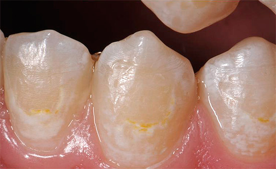 Ако кариесът е само в началния етап на развитие и засяга само зъбния емайл, лечението може да се проведе с консервативни методи.