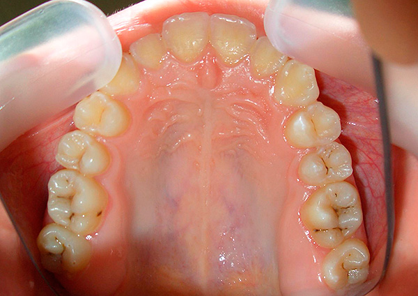 Při absenci ústní hygieny je riziko vážného zubního kazu velmi vysoké a ovlivní se nejen sklovina, ale také základní tkáně.