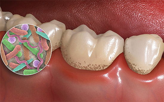 Bakterien in Plaque bilden organische Säuren, die zur Demineralisierung des Zahnschmelzes beitragen.