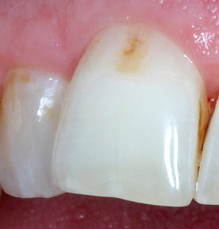 Farba zubnej skloviny postihnutej zubným kazom sa môže postupne sfarbiť na hnedú v dôsledku pigmentácie rôznymi farbivami.