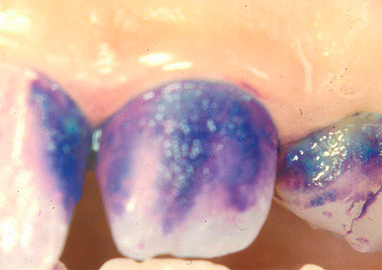 La carie conduit au fait que l'émail des dents devient poreux et se tache facilement avec divers colorants organiques, en particulier le bleu de méthylène.