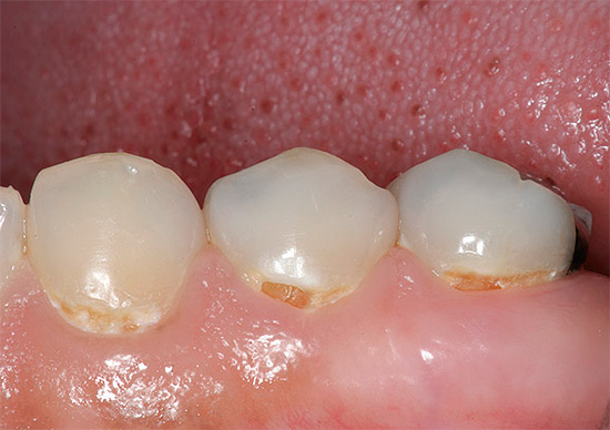 Bei der ersten Form des kariösen Prozesses können Sie ein Gefühl von Schmerzen im Mund sowie eine erhöhte Empfindlichkeit im Bereich des beschädigten Zahnschmelzes spüren.