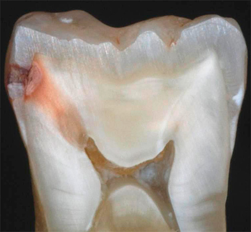 A takto vypadá skutečný zub v kontextu: je zřejmé, že zubní kaz ovlivňuje nejen smalt, ale také dentin v celé tloušťce.