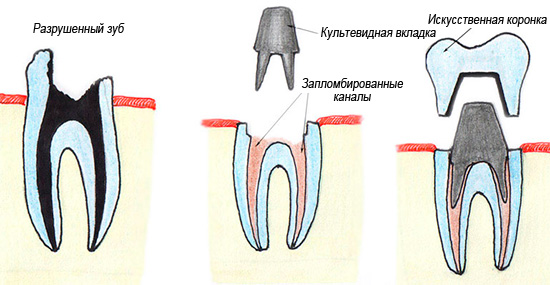 Un exemple de restauració de dents mitjançant una llengüeta i corona cultivades