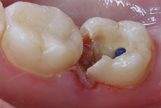 Zdjęcie zęba zepsutego przed próchnicą