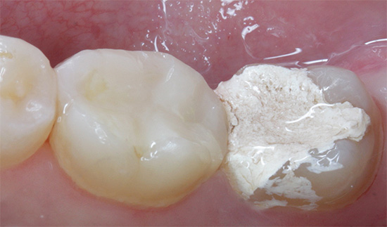 Samma tand med en tillfällig fyllning