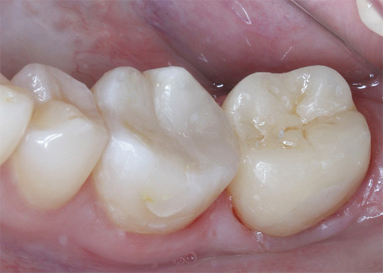 Und es sieht aus wie ein bereits versiegelter Zahn nach der Behandlung.