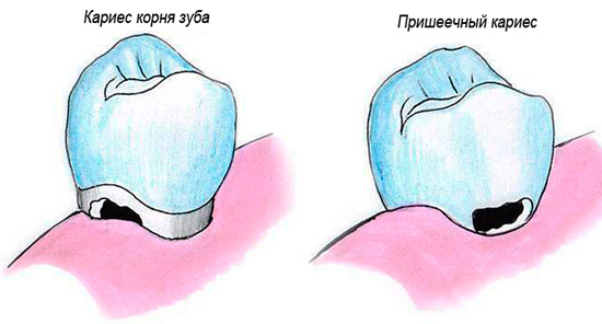 Cervikální kaz a kořenový kaz se místo jejich dislokace na zubu mírně liší
