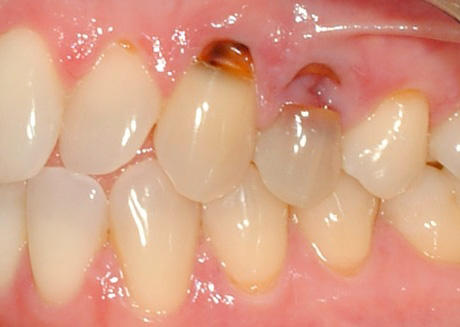 ภาพถ่ายแสดงตัวอย่างของโรคฟันผุ