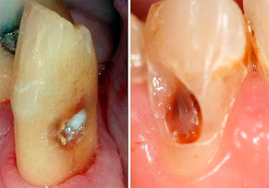 Often, destruction begins with the cervical zone, then turning into root caries.