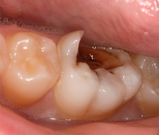 Procesul de carie început, în care o parte semnificativă a dintelui este distrusă, poate provoca, de asemenea, carii rădăcinilor