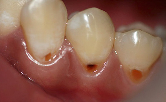 Il processo carioso nella radice del dente può passare inosservato per lungo tempo, fino a quando non si manifesta come difetti cervicali