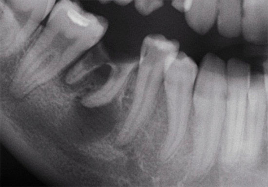 Dantų rentgeno nuotrauka: vieno iš jų šaknyje pastebima patamsėjusi sritis