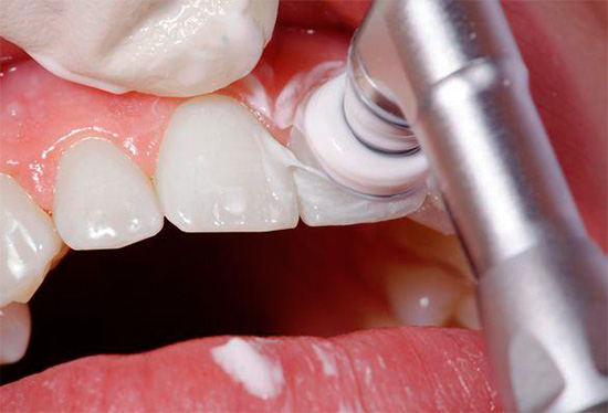 Parfois, avant le traitement de la carie dentaire, une hygiène buccale professionnelle est requise.