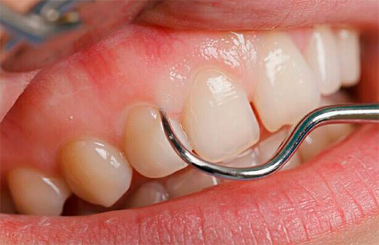När lokaliserad under tandköttet kan karies ibland fortsätta i hemlighet till ett stadium där behandling med konservativa metoder inte alltid är möjlig.