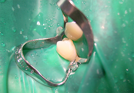 Цоффердам се стисне уз зуб стезаљком