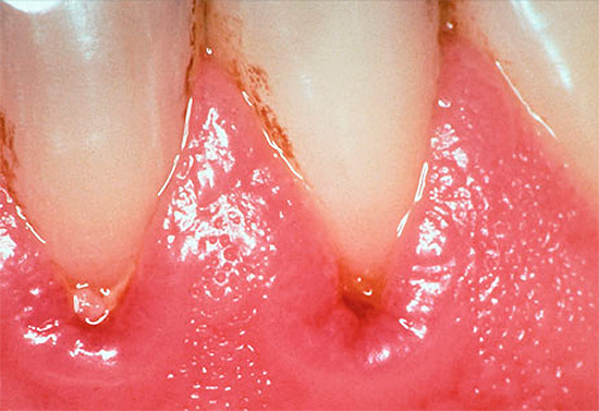 Kartais pažengusiais atvejais patologija pasireiškia kaip dantenų ir matomų danties emalio sričių pažeidimai.
