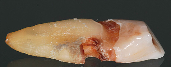 Zub s kazem kořene