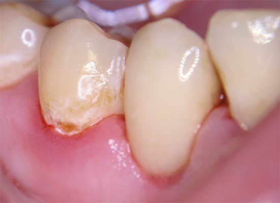 Bildet viser et eksempel på cervical karies - det ligger over tannkjøttet