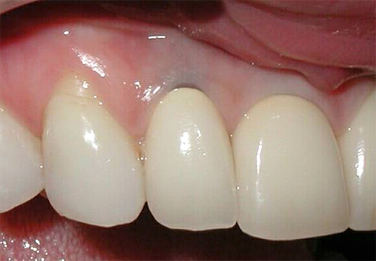 With prolonged development of caries under the gum root can be so affected that the tooth has to be removed.