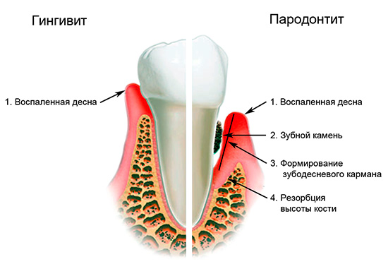 Кариес на венците често се свързва с различни усложнения, едно от които е пародонтит ...