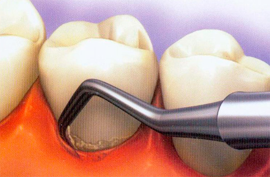 У џеповима између десни и зуба могу се акумулирати остаци хране и кариогени микроорганизми.