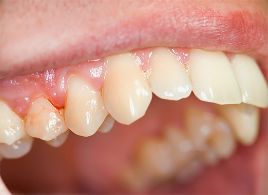 Often, patients complain not even of a tooth, but of pain in the gum