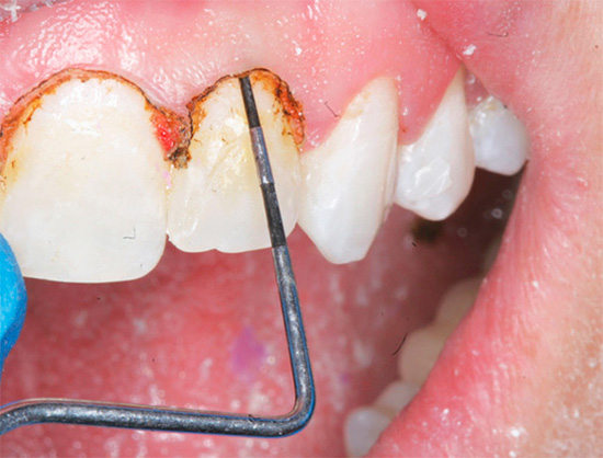 In the treatment of caries localized under the gum, often excision of soft tissues adjacent to the tooth is required.