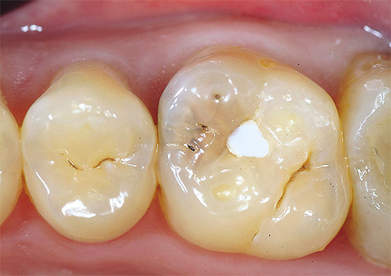 Parfois, des ciments verre ionomère sont utilisés dans le traitement des caries profondes (la dent est montrée sur la photo avant le traitement)