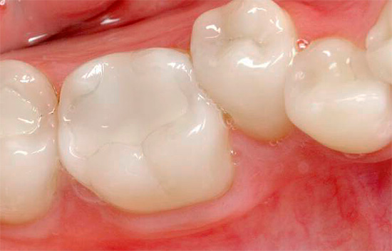 Kadang-kadang selepas memasang pengisian, rasa sakit gigi dapat dirasakan (kepekaan pasca pengisian).