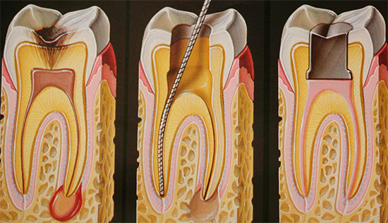 Si le développement de caries profondes a conduit à une infection de la pulpe, un traitement des canaux dentaires est nécessaire.