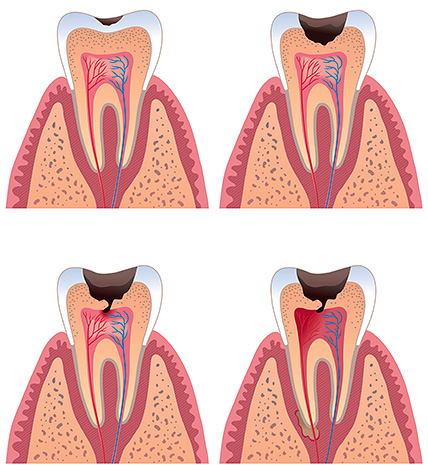 As the carious process develops, the cavity comes closer to the pulp of the tooth.