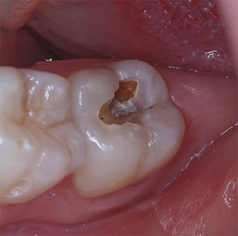 หากการรักษาโรคฟันผุไม่ได้เริ่มขึ้นทันเวลาเขาสามารถไปที่เยื่อของฟัน (ไปยังเส้นประสาท)
