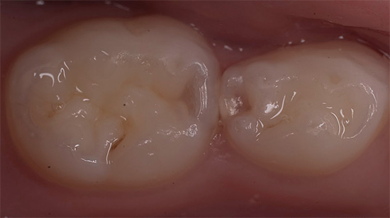 Kuva hammasta ennen täyttämistä