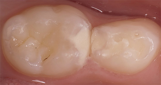 Πολλά εξαρτώνται από το πόσο καλά πραγματοποιείται η οδοντιατρική θεραπεία - εάν η σφραγίδα δεν έχει εγκατασταθεί σωστά, τότε μπορεί να εμφανιστεί βαθιά τερηδόνα (δευτερογενής) κάτω από αυτή.