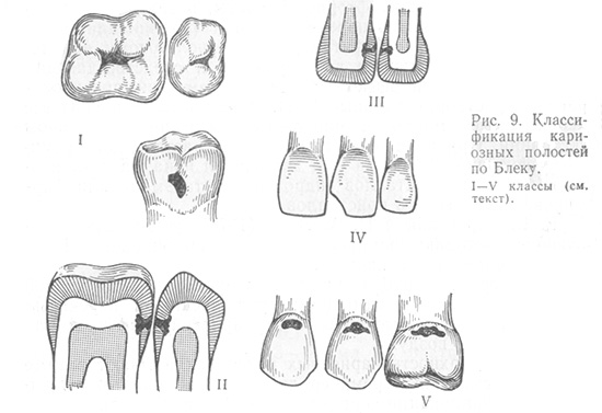 ภาพแสดงการจำแนกประเภทของฟันผุตามสีดำ