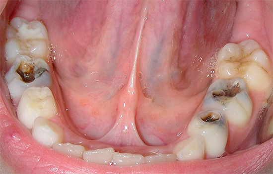 Tre tänder med djupa kariesskador syns tydligt på fotot.
