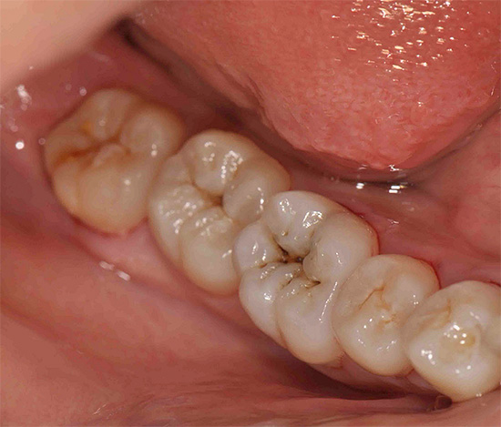 Existuje niekoľko metód na diagnostiku zubného kazu, z ktorých najúčinnejších budeme ďalej uvažovať.