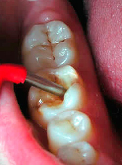 في حالة الاشتباه في التهاب لب السن ، يمكن إجراء التشخيص التفريقي عن طريق قياس كهربائية الأسنان.