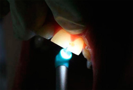 Due to the translucency of the teeth in bright light, it is possible to identify foci of caries.