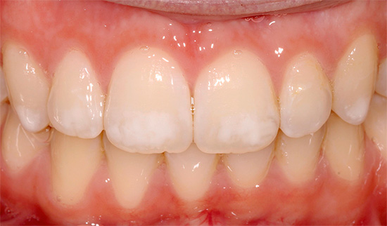 Zdjęcie pokazuje przykład fluorozy - na zębach jest wiele białych plam, ale to nie jest próchnica