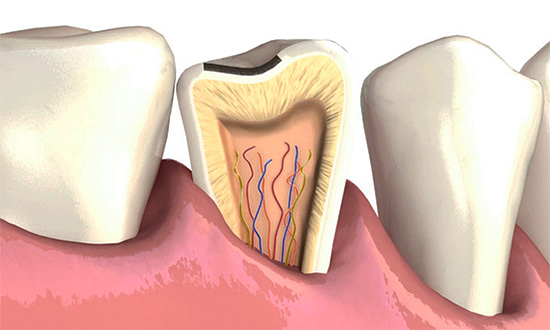 If there are significant chips on the enamel, it is important to heal them in time, since through them it is possible to develop a carious process deep into the tooth.