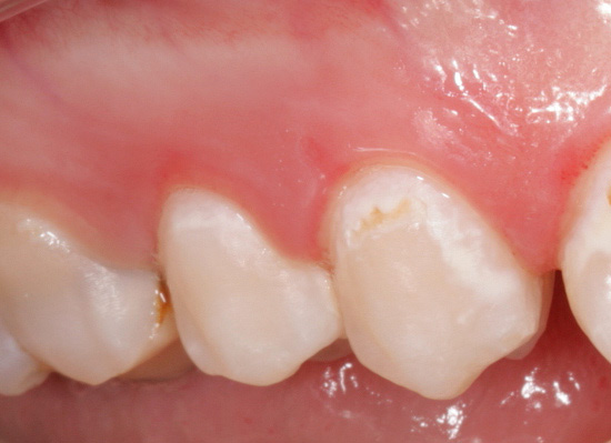 The photo shows an example of caries in the spot stage - this is the initial form of the pathological process